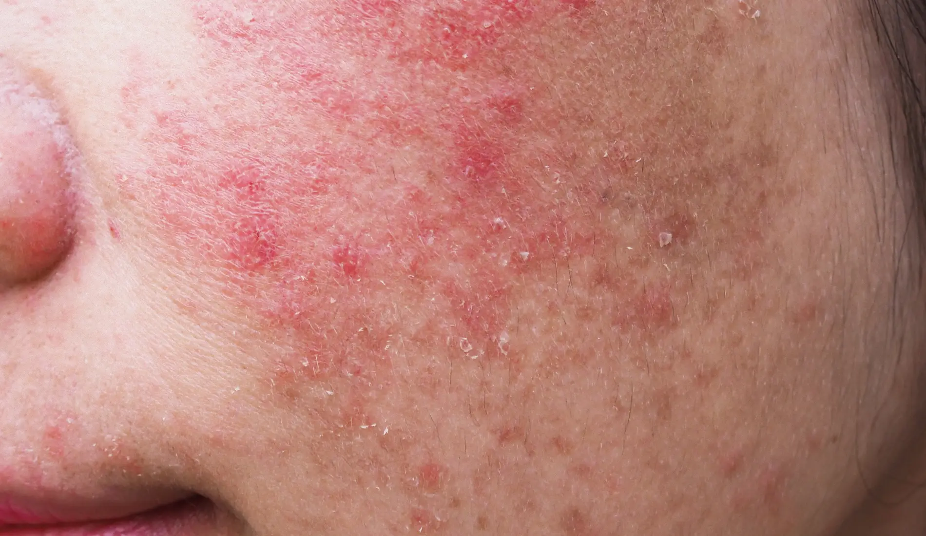 Eczéma du visage : symptômes et diagnostic